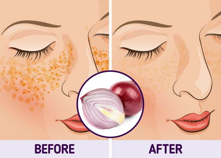 1. Đắp hành tím: Hành tím có thể hoạt động như một chất làm trắng. Về cơ bản, hành tây có thể là một phương pháp chữa nám da tại nhà hiệu quả. Lấy một củ hành tím và thái hạt lựu càng nhỏ càng tốt. Trút hành tím thái hạt lựu vào một túi trà rỗng rồi đắp lên vùng da nám. Để nước ép hành tây trên da trong 10 phút.