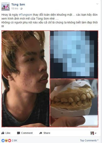 Tùng Sơn cho thấy màn lột xác đáng ngạc nhiên sau gần 1 tháng "đập đi xây lại" khuôn mặt. Có vẻ như chàng trai này đã quá chán nản khi bị chê bai vì xấu và quyết tâm "lên đời" nhan sắc.