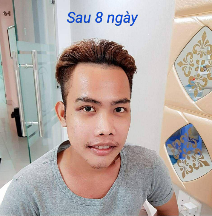 Sau cuộc đại phẫu thuật thay đổi toàn diện khuôn mặt "xấu đau xấu đớn" của mình, Tùng Sơn còn được ví như phiên bản tiếp theo của "Phượng Thị Nở" - bà mẹ đơn thân ở Đăk Nông gây sốt với quá trình "lột xác từ vịt hóa thiên nga" nhờ phẫu thuật thẩm mỹ.
