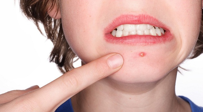 Ăn quá nhiều vải khi đang bị mụn nhọt: vải là loại quả có tính nóng nên có thể khiến cho người ăn mọc mụn nhọt, khó chịu. Nếu cơ thể bạn đang ở trong tình trạng này rồi thì bạn cần hạn chế ăn vải. Ảnh: Cách trị mụn trứng cá.