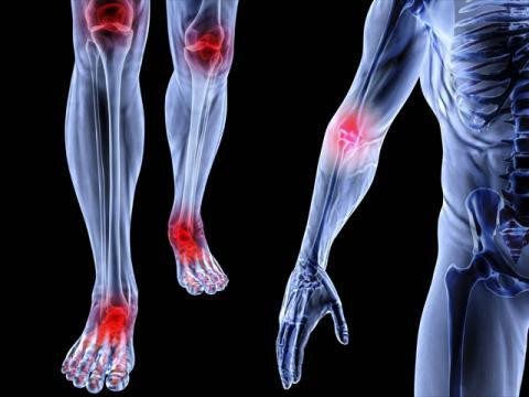 Người bị tai nạn, ngã lâu ngày dẫn đến đau xương khớp thậm chí là viêm xương tủy… có thể lấy ráy leo sắc lên uống, đồng thời hòa bột cây ráy leo với dấm để đắp trực tiếp lên vết thương. Ảnh: Chữa trị bệnh khớp.