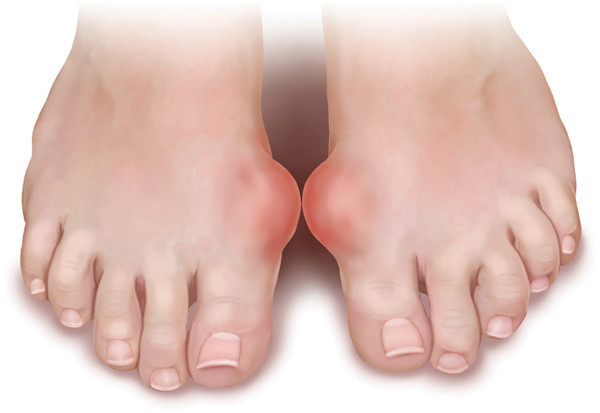 Người đang bị bệnh gout hoặc có tiền sử bị bệnh gout cần tránh thịt vịt vì lượng chất béo và protein trong thịt vịt là rất cao. Nếu người bệnh ăn quá nhiều sẽ thúc đẩy axit uric tăng lên không tốt cho bệnh tình. Ảnh: Zing.