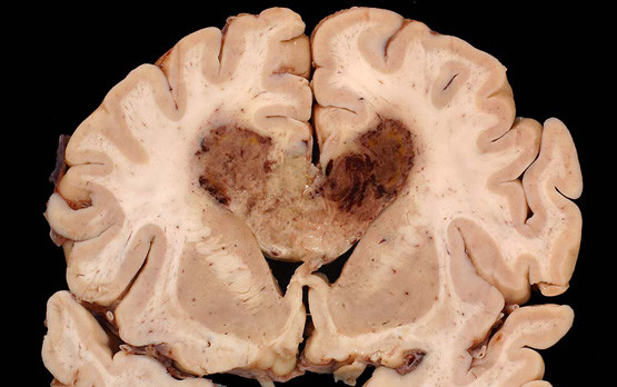 Ung thư Glioblastoma đây là thể nguy hiểm hơn của ung thư glioma trong đó tế bào không biệt hóa. Ảnh: ucsdnews.