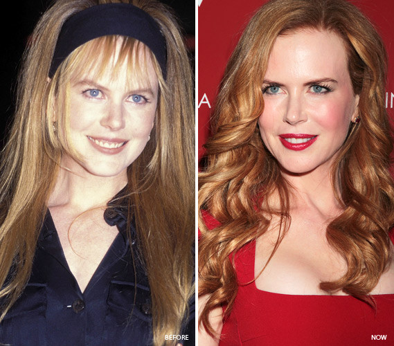 Nicole Kidman là một trong những ngôi sao dính nhiều nghi vấn dao kéo để níu kéo tuổi xuân bởi khi so sánh hình ảnh của cô bây giờ và trước đây rất lâu vẫn không khác là mấy. Khuôn mặt, khóe mắt, môi, trán của cô không một nếp nhăn.