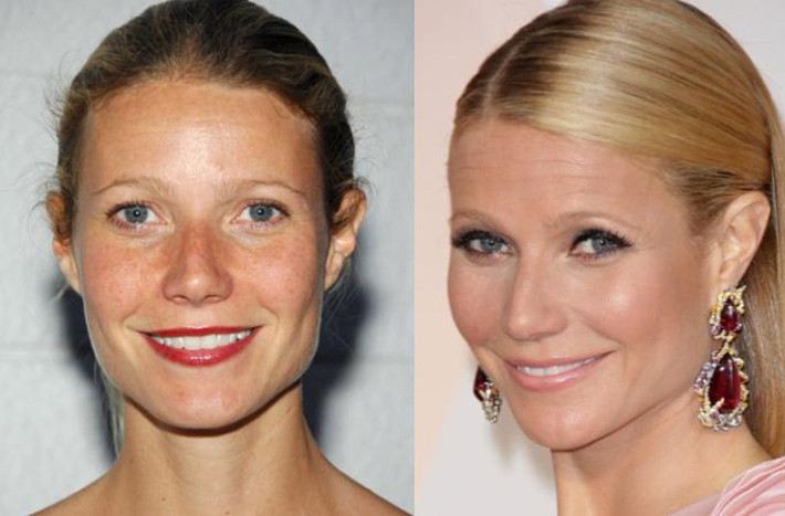 Gwyneth Paltrow cũng thừa nhận cô đã từng thử tiêm Botox và sau đó cô cảm thấy mình trẻ hơn tới 5 tuổi. Nhưng sau lần đó ngôi sao Hollywood đã không muốn lặp lại quy trình làm đẹp này nữa cho tới khi chạm ngưỡng 50. Trong ảnh là gương mặt Gwyneth năm 2007 và 2015 (phải).