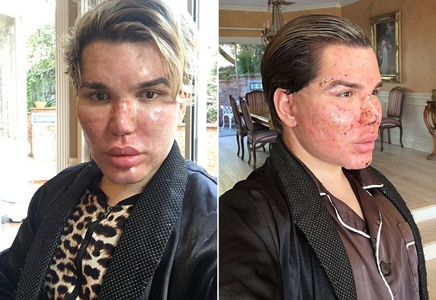 Rodrigo Alves tâm sự chỉ vì khuôn mặt như thế mà anh phải bỏ lỡ bữa tiệc sao Oscar do Elton John tổ chức. (Ảnh: Daily Mail)