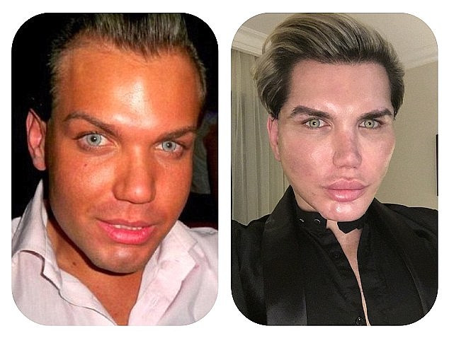 Rodrigo Alves, 33 tuổi, người Brazil, không hài lòng với ngoại hình của mình và bỏ ra 368.000 bảng Anh để thay đổi. (Ảnh: Daily Mail)