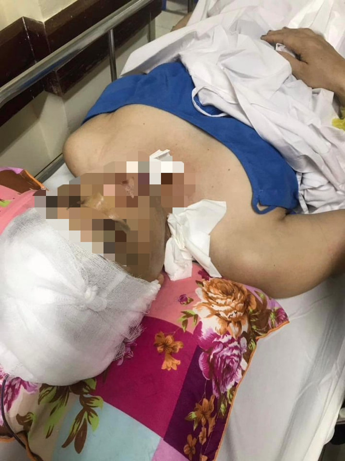 Hậu quả vụ việc khiến ông Hanh bị gãy răng hàm dưới, gãy xương mũi và chấn thương vùng đầu phải đi bệnh viện cấp cứu.