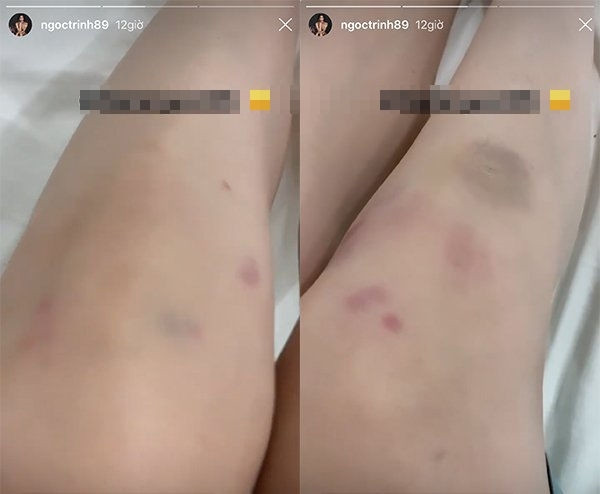 Thế nhưng gần đây, Ngọc Trinh bất ngờ để lộ đôi chân với những vết bầm tím khiến fan của cô không khỏi xót xa.