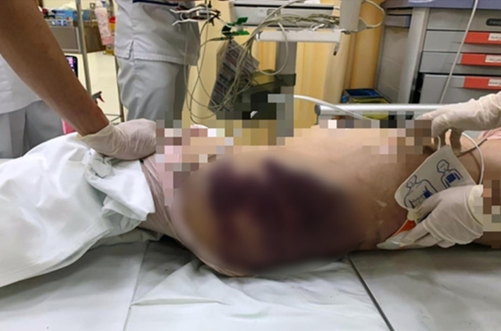 Đến khoảng 18h, cháu V.A có biểu hiện mệt nên vào phòng nằm nghỉ. Một lúc sau Trang vào kiểm tra phát hiện cháu V.A ói và tình trạng yếu nên gọi cho N.K.T.T về. Lúc này, T. cũng vừa đi làm về đến chung cư nên gọi cấp cứu đưa cháu bé đến bệnh viện nhưng cháu không qua khỏi.