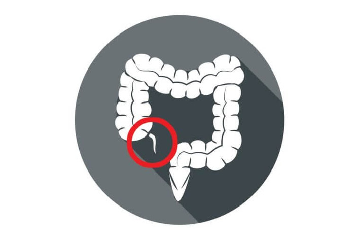 Trong một số trường hợp bệnh nặng, ruột thừa có thể bị phẫu thuật cắt bỏ.