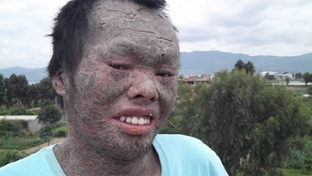 Minh Anh được gọi là cậu bé người cá. Cậu mắc phải một tình trạng lạ khiến da tróc vảy. Các bác sĩ tin rằng điều này có thể là do chất độc màu da cam, hóa học được sử dụng bởi quân đội Mỹ trong chiến tranh ở Việt Nam.