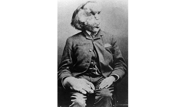 Joseph Merrick, sinh ra ở London vào những năm 1830, ông bị hội chứng proteus, gây ra khối u khổng lồ hình thành khắp cơ thể.
