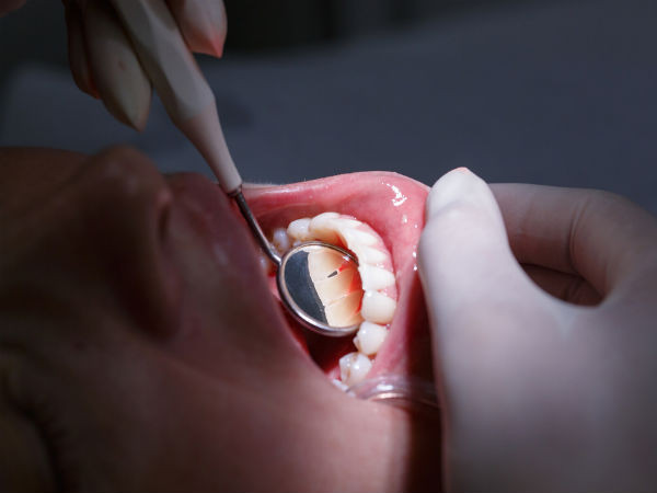 Sữa chua có thể chống lại các loại sâu răng làm xói mòn men răng. Sữa chua chứa axit lactic bảo vệ lợi của bạn khỏi vi trùng và thực phẩm bám vào. Ảnh: Boldsky.