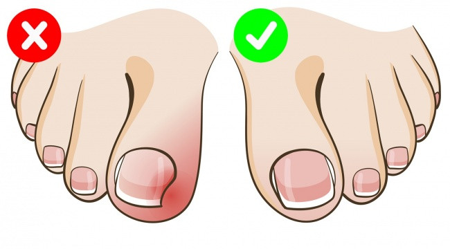 Cắt cụt móng chân quá mức sẽ khiến bạn gặp khó khăn khi đeo tất và đi bộ. Khi móng chưa kịp mọc, lớp da chân sẽ chèn lên, gây sưng phù khi bạn đi bộ nhiều. Ảnh: Depositphotos.