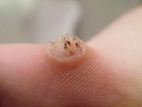 Mụn cóc mọc ở chân đây là căn bệnh ở chân thường gặp ở hầu hết mọi người.