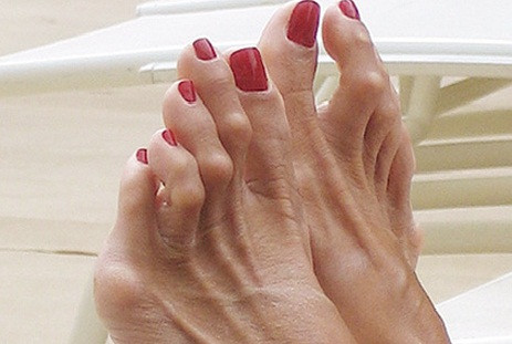 U cục biến dạng ngón chân cái có tên tiếng Anh là bunion. Những u cục này gây khó chịu và đau đớn, khiến bàn chân xấu xí.