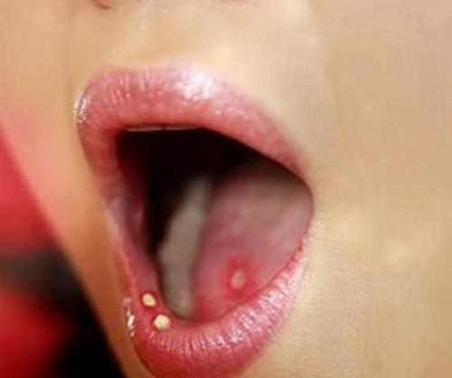 Có nhiều dạng kích ứng mãn tính, thường gặp nhất là hút thuốc, uống rượu, phơi nắng, thiếu dinh dưỡng, xạ trị và vệ sinh răng miệng kém. Một số kích ứng cục bộ, chẳng hạn như kích ứng mãn tính do chân răng còn sót lại và răng giả không đủ tiêu chuẩn.