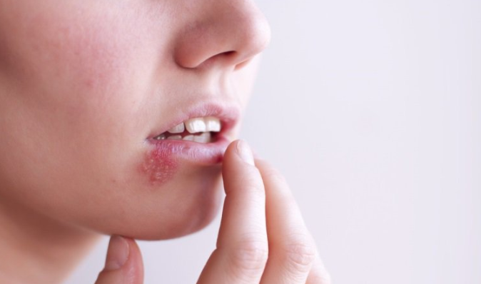 Trong y học, viêm loét miệng là một bệnh lý răng miệng có tỷ lệ người mắc cao, đây thực chất là vết loét nông trên niêm mạc miệng. Các vết loét ở miệng hầu hết có kích thước bằng hạt gạo hoặc hạt đậu nành, bề mặt vết loét bị lõm xuống, xung quanh sẽ xuất hiện các triệu chứng xung huyết, phù nề, trông giống bề mặt của mặt trăng.
