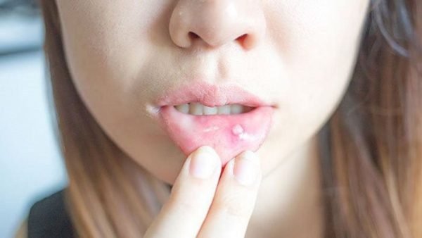 Loét miệng lâu ngày không lành có phải là dấu hiệu của bệnh ung thư? Chính vì đau là triệu chứng chính của bệnh nhân viêm loét miệng nên nhiều người lo lắng rằng vết loét miệng lâu ngày không lành sẽ trở thành ung thư.