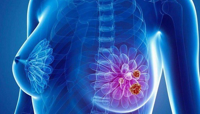 1. Ung thư vú: Các nghiên cứu liên quan đã chỉ ra rằng, nếu người mẹ bị ung thư vú trước khi mãn kinh, nhất là khi còn trẻ mà xuất hiện ung thư cả hai vú thì nguy cơ mắc ung thư vú ở thế hệ sau cao gấp 9 lần so với những phụ nữ khác.