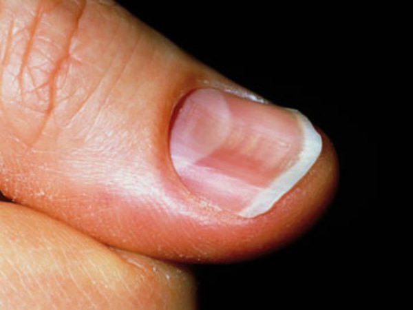 Trong cuộc sống hàng ngày, hãy chú ý nhiều hơn đến tình trạng của móng chân, nếu phát hiện có dấu hiệu bất thường nên đi khám kịp thời, tuyệt đối không nên trì hoãn, có thể gây ra những hệ quả rất khó chịu về sau.