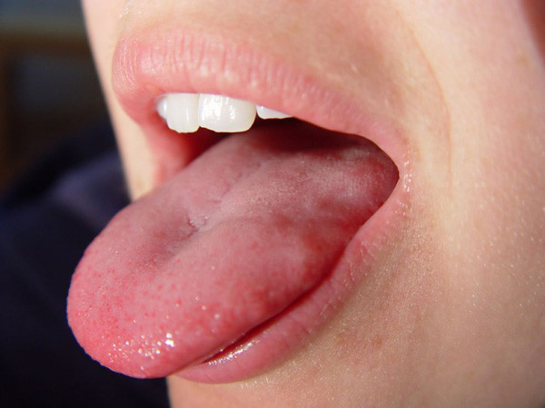 Cảnh báo nhiễm trùng: Nếu lớp phủ trắng ở lưỡi khá nặng, ngoài việc xem lại thói quen sinh hoạt của bản thân, tốt hơn hết bạn nên đi kiểm tra càng sớm càng tốt, vì nhiễm nấm Candida ở miệng cũng có thể khiến lớp phủ trắng ở lưỡi dày lên.