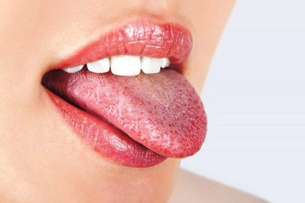 Lớp phủ lưỡi có màu khác thường: Theo các bác sĩ, cấu trúc của lớp phủ lưỡi chủ yếu bao gồm các tế bào biểu mô, nước bọt, vi khuẩn và mảnh vụn thức ăn. Thông thường, lớp phủ lưỡi sẽ có màu trắng và mỏng. Khi bị cảm lạnh, bệnh tật hoặc thiếu nước, lớp phủ lưỡi dễ bị tích tụ và dày lên, tạo thành lớp phủ trắng dày hơn ở lưỡi.