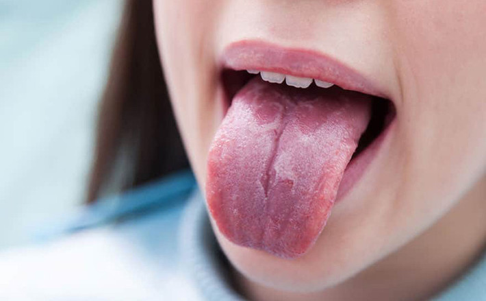 Cảnh báo ung thư: Khi một người trưởng thành có lớp phủ lưỡi màu đỏ hoặc trắng, nếu có sự bất đối xứng trái-phải, hình dạng bất thường, hoặc thậm chí có vết loét, thì đó thường không phải là lớp phủ lưỡi bình thường, mà là bạch sản miệng, ban đỏ miệng, dấu hiệu của ung thư miệng.