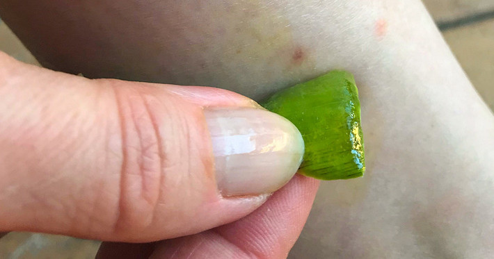Giảm ngứa do côn trùng cắn: Gel lô hội có khả năng làm giảm ngứa và giảm viêm ở các vết thương do côn trùng cắn. Bạn chỉ cần đặt một chút gel lô hội lên vết thương, để khô tự nhiên. Lặp lại cho đến khi vết thương không còn thấy ngứa.