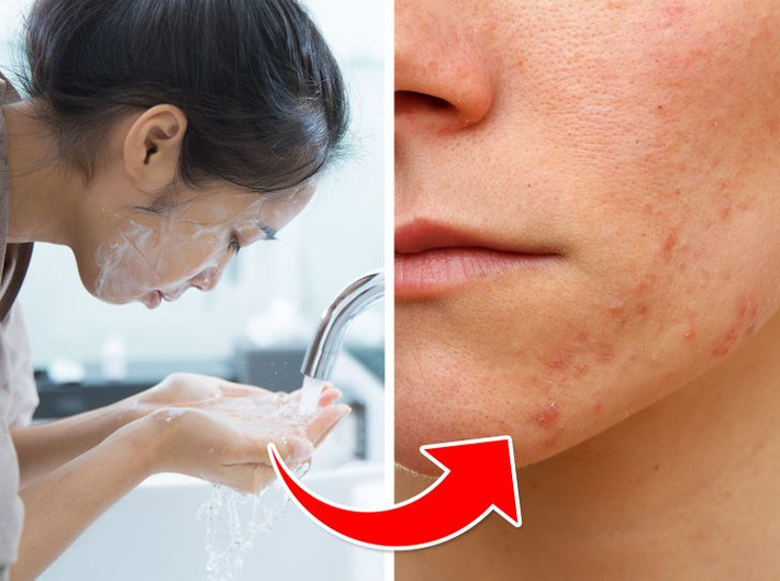 4. Rửa mặt quá nhiều: Làm sạch da là bước cần thiết để chống và ngăn ngừa mụn, nhưng rửa quá nhiều thì sẽ gây ra tác động ngược lại. Các bác sĩ da liễu cho rằng rửa mặt quá nhiều có thể làm đảo lộn sự cân bằng trên da. Sử dụng quá nhiều sản phẩm giúp làm khô dầu thừa sẽ khiến da bị khô quá mức, làm tuyến dầu tự nhiên tiết ra nhiều hơn, cuối cùng là mụn sẽ xuất hiện.