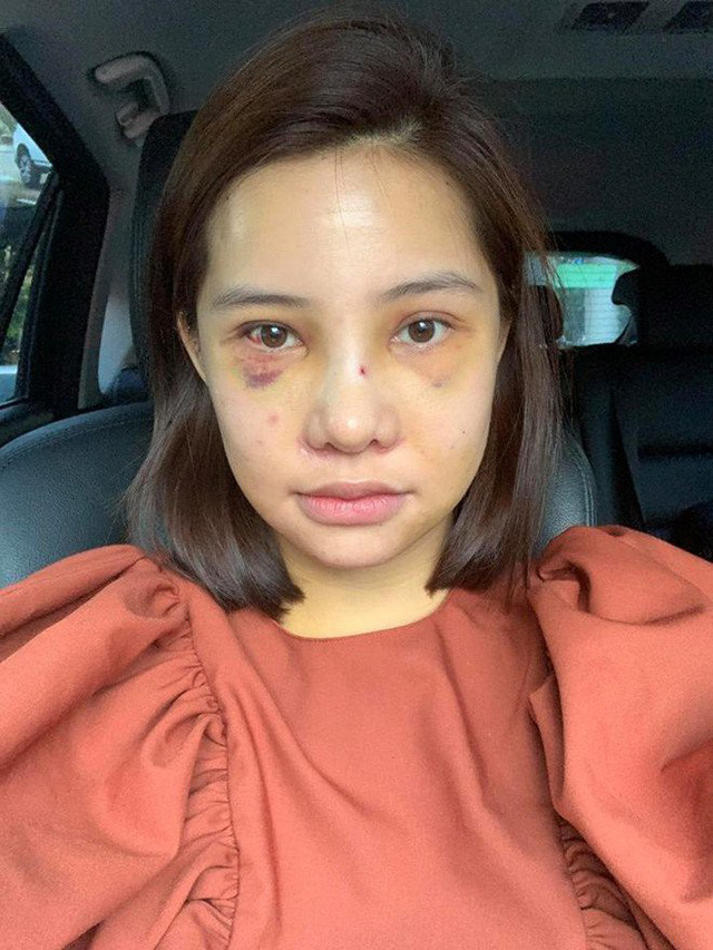 Ngày hôm qua, Lưu Đê Ly gây xôn xao khi công khai chuyện "đập đi xây lại" toàn bộ gương mặt. Cô vốn hài lòng với gương mặt trước đây của mình nhưng vẫn quyết định phẫu thuật thẩm mỹ "để hồi xuân" và muốn mình xinh hơn.