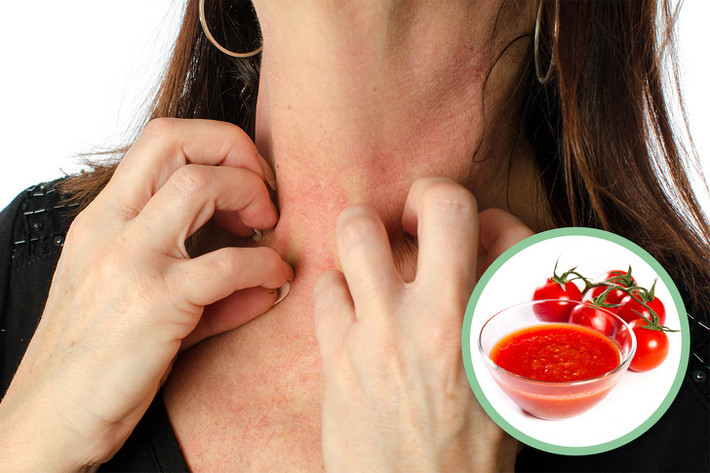 Phản ứng dị ứng khá phổ biến: Cà chua chứa một hợp chất gọi là histamine, giúp tăng cường hệ thống miễn dịch để chống lại những kẻ xâm lược "lạ mặt". Điều đó thường xuất hiện dưới dạng các phản ứng dị ứng như phát ban và sưng lưỡi, trong số các tác dụng khó chịu khác.