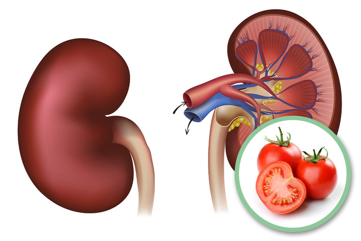 Một số cá nhân gặp vấn đề về thận: Cà chua dẫn đến sự tích tụ canxi trong cơ thể. Thêm vào đó, thực tế là cà chua cũng rất giàu một thứ gọi là oxalate, một chất không được chuyển hóa dễ dàng khi tiêu thụ quá mức và nó có thể dẫn đến sỏi thận. Cà chua cũng rất giàu kali, có thể làm suy giảm chức năng thận. Nếu bạn đã bị các vấn đề về thận, hãy lưu ý thêm về điều này.