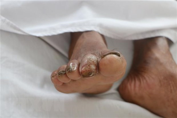 Trước đó, sáng 9/9, ông H. được người thân đưa vào nhập viện tại Khoa Nội tiết, BV đa khoa tỉnh Hà Tĩnh trong tình trạng sốt cao, 2 ngón bàn chân phải sưng, chảy dịch. Tại đây, các bác sĩ lấy máu của bệnh nhân nuôi cấy và cho kết quả dương tính với vi khuẩn “ăn thịt người” Burkholderia Pseudomallei (bệnh Whitmore). Đến chiều 12/9, các bác sĩ thấy ông H. có dấu hiệu bệnh nặng thêm nên đã chuyển bệnh nhân ra BV Bạch Mai. Ảnh minh họa.
