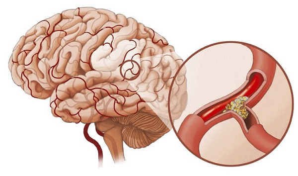 Xuất huyết não dẫn đến đột quỵ đang tăng nhanh đáng sợ ở cả người già lẫn người trẻ. Để phòng ngừa xuất huyết não, theo các chuyên gia cần kiểm soát huyết áp, loại bỏ những thói quen không lành mạnh.