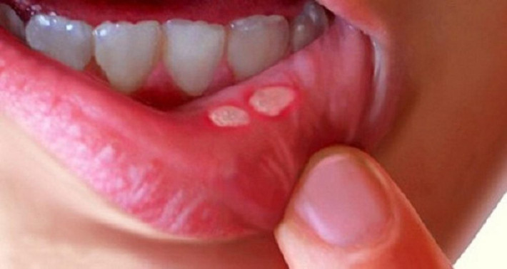 Nước lá húng chanh cũng có thể sử dụng làm bài thuốc ngậm để chữa nhiệt miệng. Mỗi ngày bạn ngậm nước này 4-5 nốt nhiệt trong miệng sẽ rất nhanh khỏi.