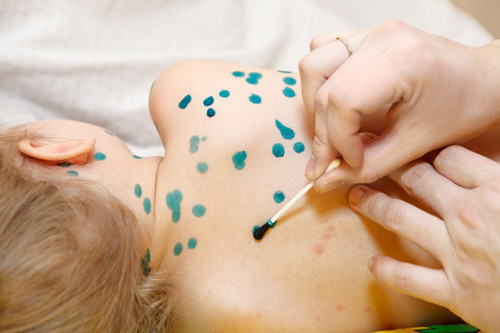 Bôi chấm nước các loại lá cây theo truyền miệng trên mạng để giảm mụn thủy đậu: Cách chữa bệnh thủy đậu này là một sai lầm nhiều người mắc phải. Nếu bạn tự ý bôi chấm các loại lá không rõ nguồn gốc lên vết mụn rất dễ gây nhiễm trùng bội nhiễm.