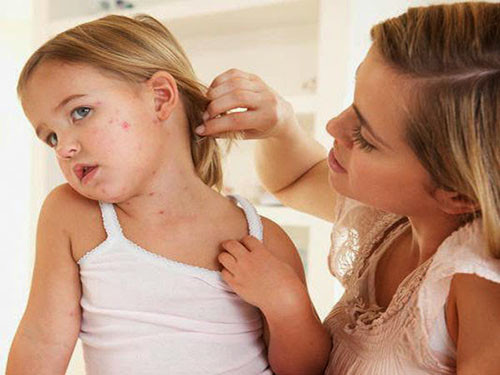 Tự chọc vỡ mụn mủ để bệnh thủy đậu nhanh khỏi cũng là quan niệm cực kỳ sai về bệnh thủy đậu. Việc bạn tự chọc vỡ mụn nước có thể mụn lây lan nhiều hơn, da bạn dễ nhiễm trùng bội nhiễm rất nguy hiểm. Nguồn ảnh: Kênh sức khỏe, Đời sống pháp luật.