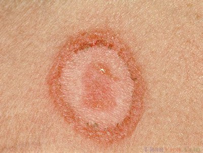 Theo thông tin đăng tải trên trang viện y học ứng dụng, bạn hoàn toàn có nguy cơ bị herpes mảng tròn khiến da bạn bị phát ban đóng vảy thành những nốt đỏ, tròn trên da hoặc một mảng hói trên da đầu.