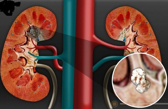 Đặc biệt ở trẻ nhỏ, việc nhiễm trùng có thể gây biến chứng sẹo thận, tiền cao huyết áp. Việc nhịn tiểu làm trào ngược bàng quang niệu quản gây nhiễm trùng thận, dẫn đến suy thận, có thể gây tử vong.