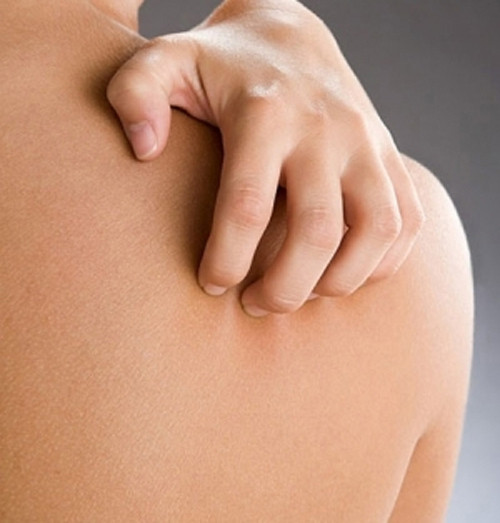 Thực tế, hầu hết các sản phụ bị nổi mề đay, ngứa sau là do thay đổi hormone, do tăng men gan quá cao gây ra. Ảnh: Icare, sống khỏe, MD.