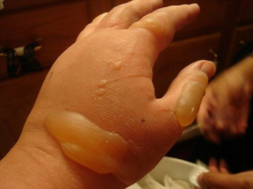Ngoài ra, bạn có thể nấu cao bằng thịt bí ngô để dành thoa vào vết bỏng, hoặc thái mỏng phơi khô tán bí thành bột mịn, khi sử dụng hòa tan chúng với lòng trắng trứng gà hay trứng vịt bôi vào vết bỏng. Ảnh: Bacsi.