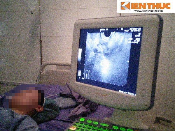 Bác sĩ theo dõi để thực hiện chọn lựa và hút trứng qua màn hình máy siêu âm.