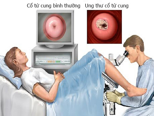 Phụ nữ từ 21 tuổi trở lên nên tầm soát ung thư cổ tử cung định kỳ theo chỉ dẫn của bác sĩ.