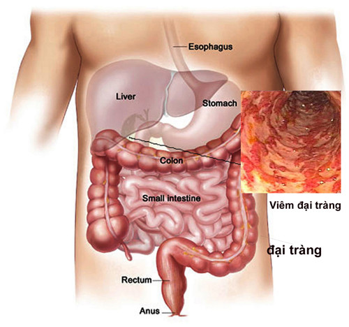 Bước 4: Sinh thiết sét nghiệm xem u đại tràng bạn mắc nếu có lành tính hay ác tính.