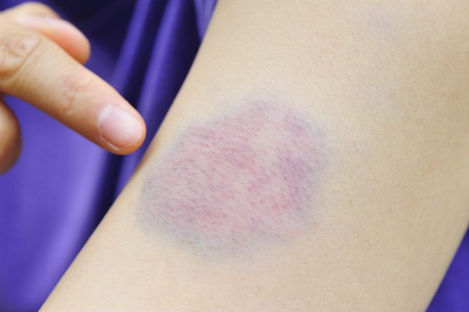 Làm mờ vết thâm tím: Dùng một miếng bông vào dung dịch giấm táo nguyên chất rồi để trực tiếp lên vùng da bị thâm tím trong vòng 1 tiếng đồng hồ, vết thâm sẽ tan dần nhờ thành phần kháng viêm có trong giấm táo.
