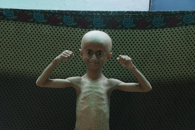 Tổ chức Nghiên cứu Progeria cho rằng hội chứng này rất hiếm gặp, cứ khoảng 20 triệu người mới có một trường hợp mắc bệnh. Ảnh: The Sun.