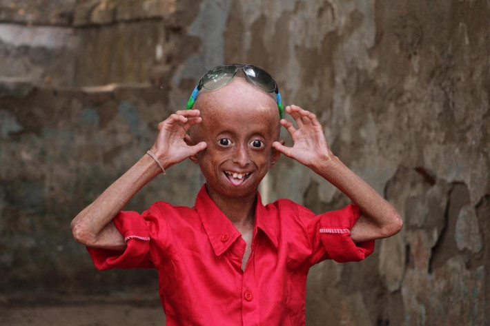 Ông Arvind nói: "Thằng bé mắc chứng progeria nhưng nó không bao giờ cho phép chúng tôi cảm thấy nó đang bị bệnh. Thằng bé luôn dành thời gian để chơi và hát. Chơi cricket là một trong những hoạt động yêu thích của nó”. Ảnh: The Sun.