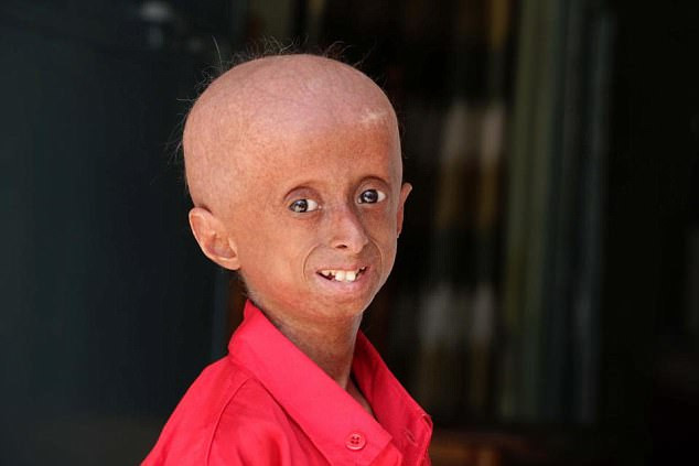 Shreyash Barmate mắc phải tình trạng di truyền cực hiếm gặp được gọi là progeria, điều này khiến cơ thể cậu lão hóa nhanh gấp 8 lần người thường. Ảnh: The Sun.